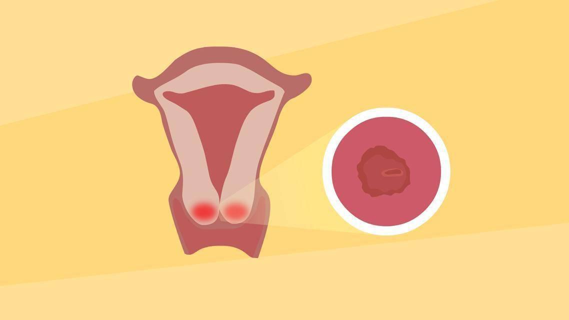 哪些不良習(xí)慣會(huì)引發(fā)宮頸糜爛