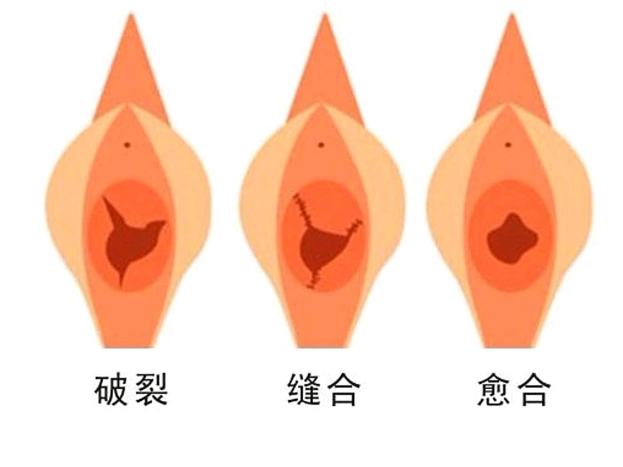 處女膜修復(fù)多少錢