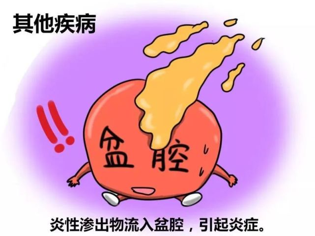 盆腔炎的病因有哪些