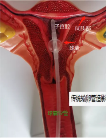 做輸卵管造影有無痛的嗎